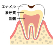 むし歯がエナメル質まで進んだ状態の歯のイラスト