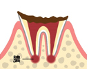 むし歯が進み、歯の上部が崩壊している状態のイラスト