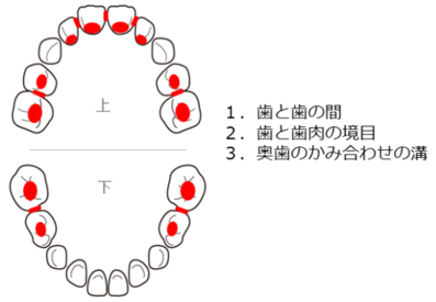 むし歯にになりやすい 歯と歯の間 歯と歯肉の境目 奥歯のかみ合わせを赤く示している乳歯のイラスト