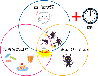 糖質と歯の質とむし歯菌が重なり時間が経過するとむし歯になりやすいことを示すイラスト