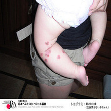 赤ちゃんの足の吸血被害の写真