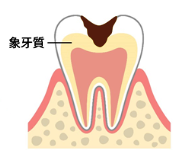 むし歯が象牙質にまで進んだ状態の歯のイラスト