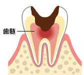 むし歯が神経（歯髄）まで進んだ状態の歯のイラスト