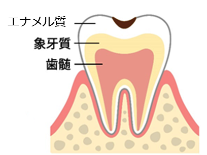 エナメル質の虫歯