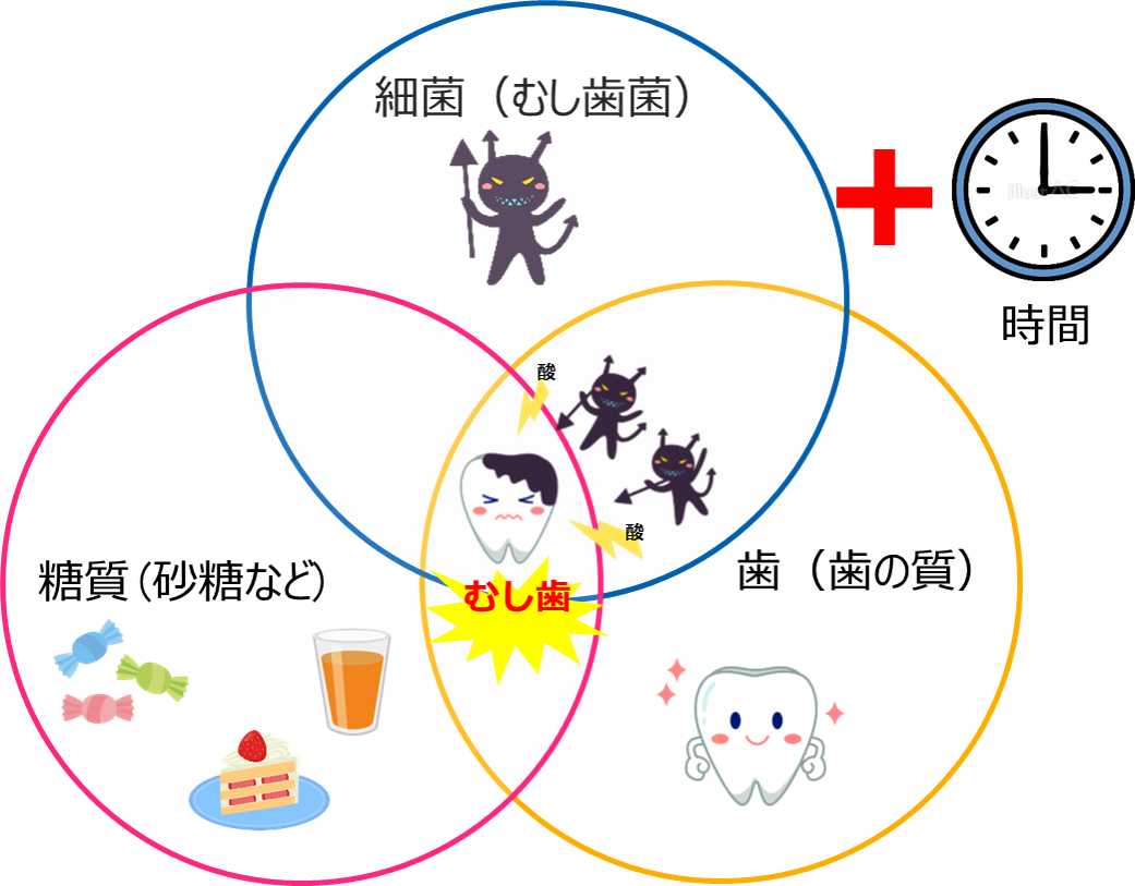 虫歯の原因（カエスの輪）