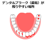 歯と歯の汚れ