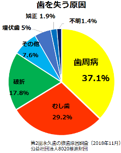 歯を失う原因を示すグラフ　第2回永久歯の抜歯原因調査によると歯を失う原因は歯周病が37.1％　むし歯は29.2％であった