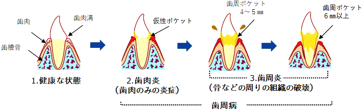 歯周病の進み方を示すイラスト